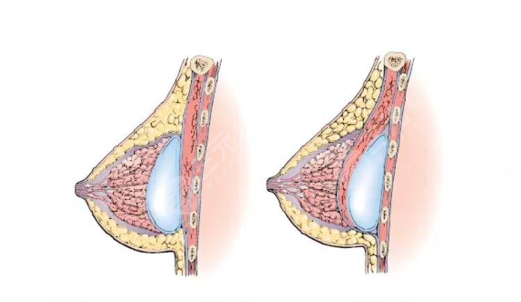 隆胸手术原理