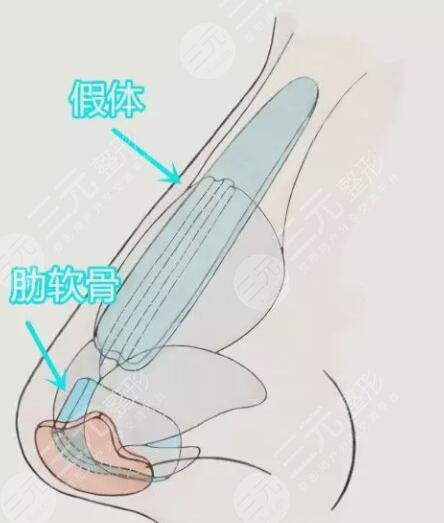 鼻部整形手术之后需要做哪些护理果会恢复的更快一些