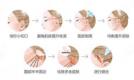 面部拉皮除皱科普