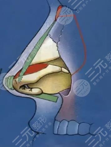 肋软骨隆鼻