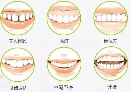 牙齿矫正相关知识科普:牙齿矫正需要多长的时间?