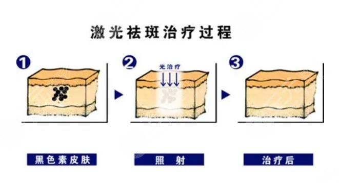 激光祛斑