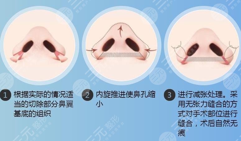 苏州薇琳美容医院热门项目科普——鼻翼整形