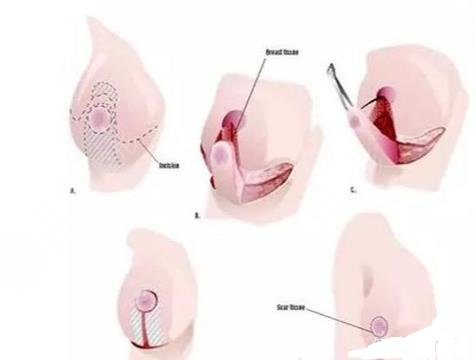 棒棒糖法缩胸手术的原理