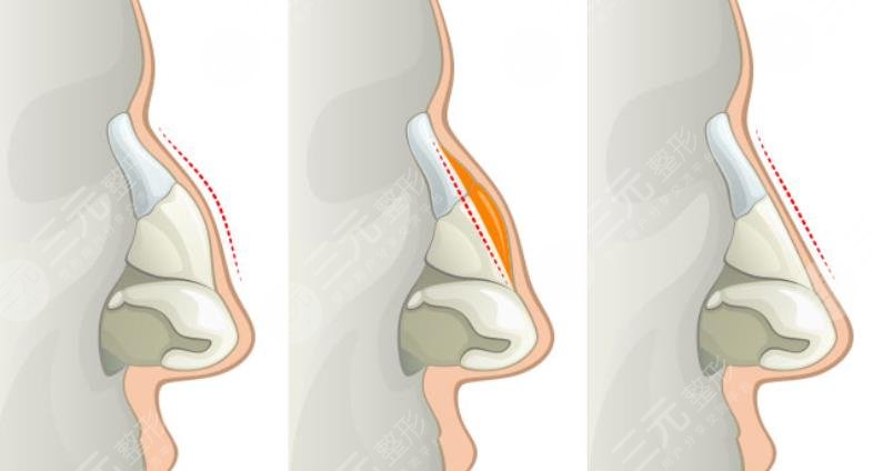 驼峰鼻矫正原理