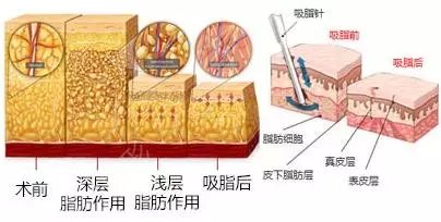 抽脂手术对身体有什么副作用