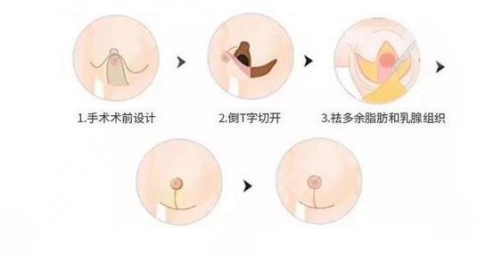 乳房缩小整形术有风险吗?