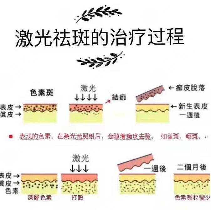 激光去雀斑