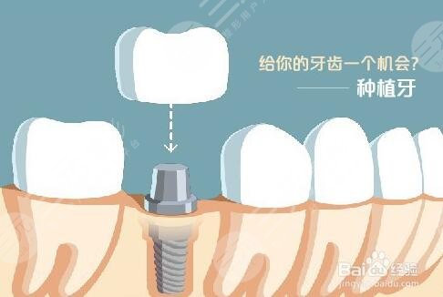 牙齿掉了镶牙好还是种植牙好呢