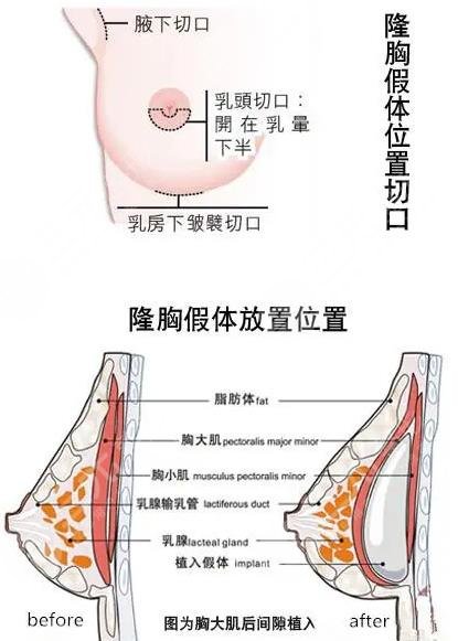 隆胸手术是怎样做的