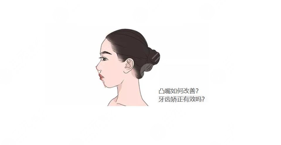 摆脱凸嘴|用口呼吸怎么矫正?牙齿矫正真的有吗?保姆级指南~