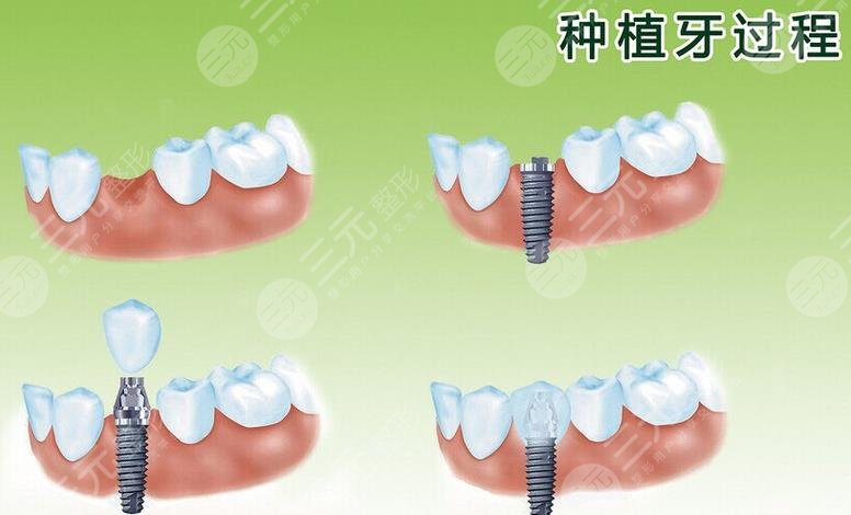 牙齿种植手术