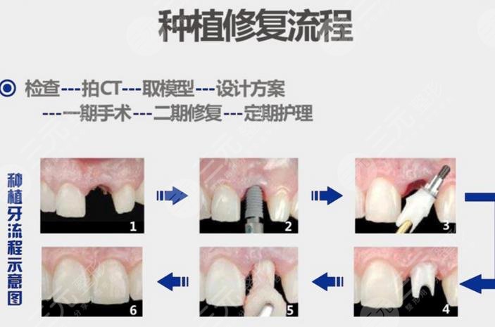 牙齿种植