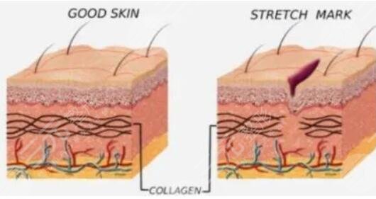 妊娠纹产生的原因