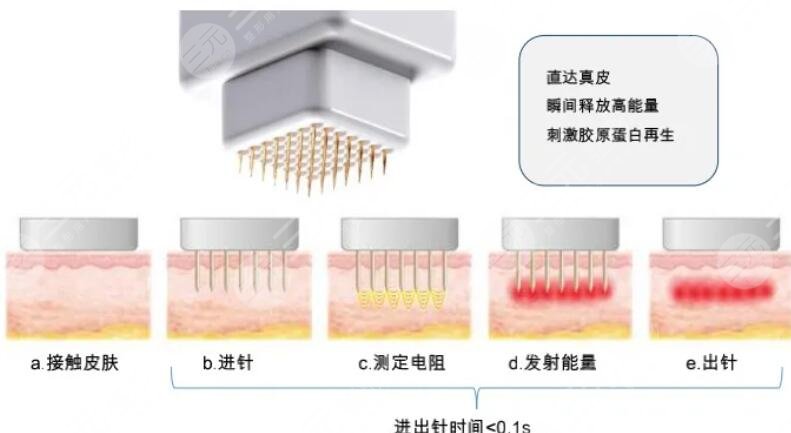 黄金微针