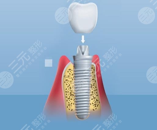 天津种植牙手术经历分享