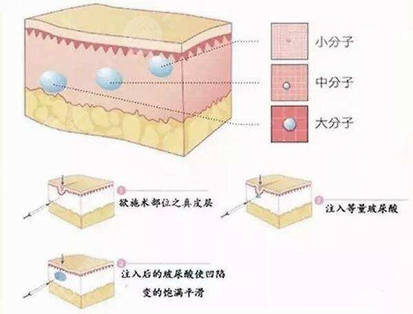 玻尿酸注射