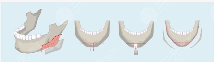 下颌角磨骨手术大概多少钱?果如何?优势+注意事项解答~