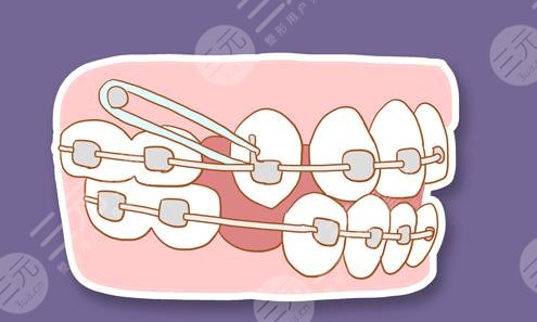 天津美奥口腔医院牙齿矫正分享