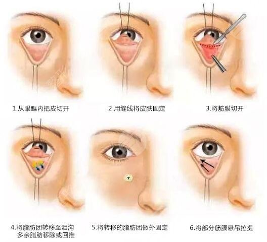 去眼袋手术应该选择什么时候来做?