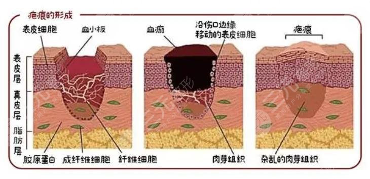 疤痕