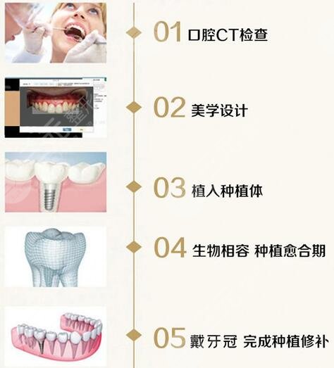 北京中诺口腔医院科普牙齿种植手术的原理