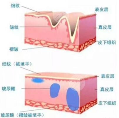 玻尿酸除皱有什么危害吗