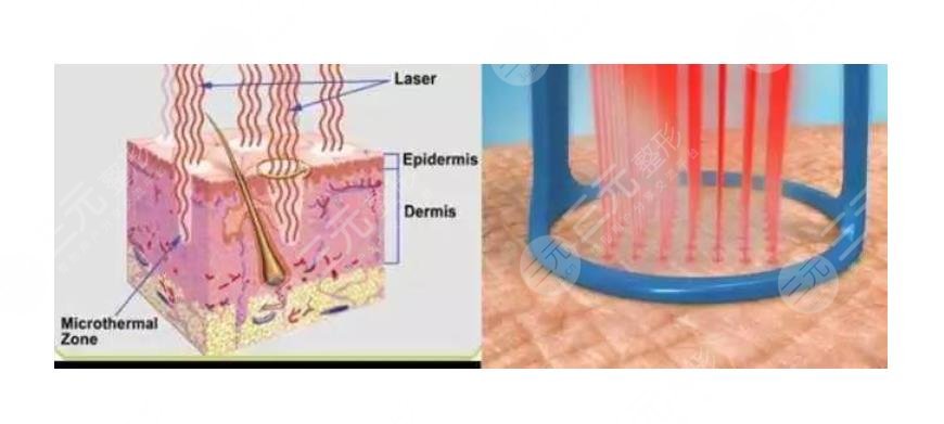 皮肤科项目科普——点阵激光