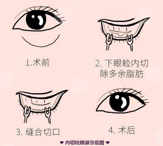 内切去眼袋的概念