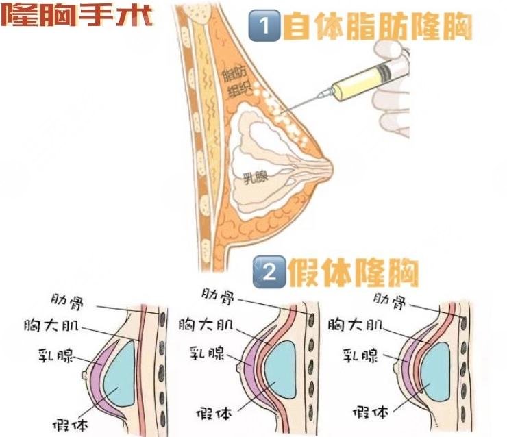 温州隆胸好的医院