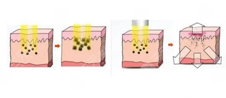 激光祛斑原理