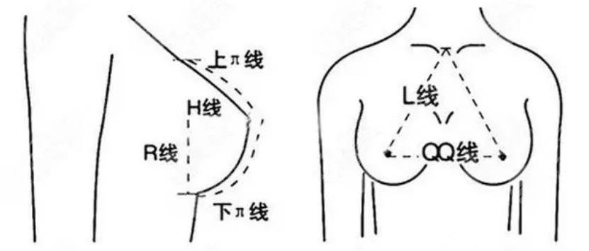 隆胸手术