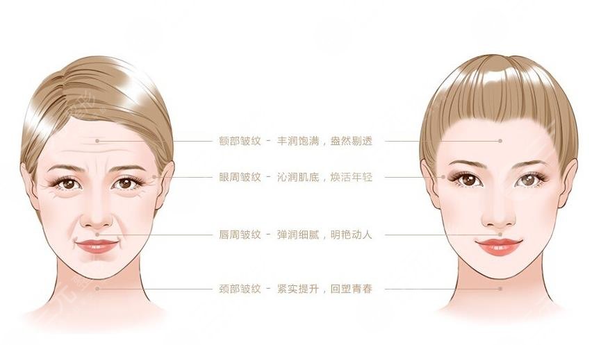 射频除皱使用部位、特性科普