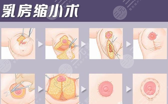 乳房缩小棒棒糖手术法是什么?