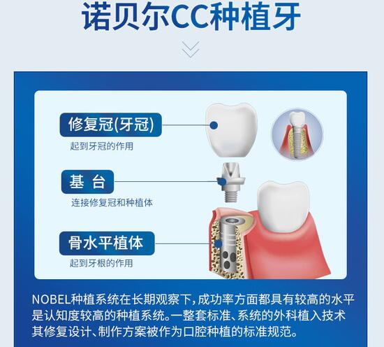 南京美奥口腔医院科普种植牙手术知识