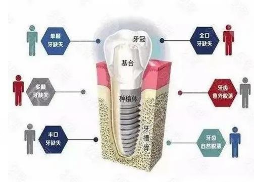 牙齿种植