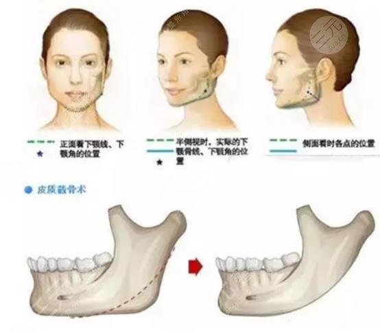 下颌角整形的操作方式