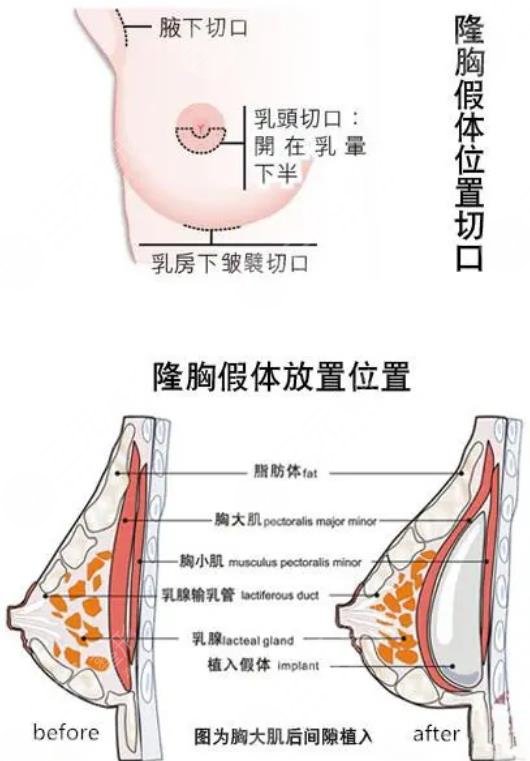 隆胸手术果可以维持一辈子吗