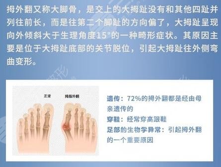 大脚骨可以矫正吗