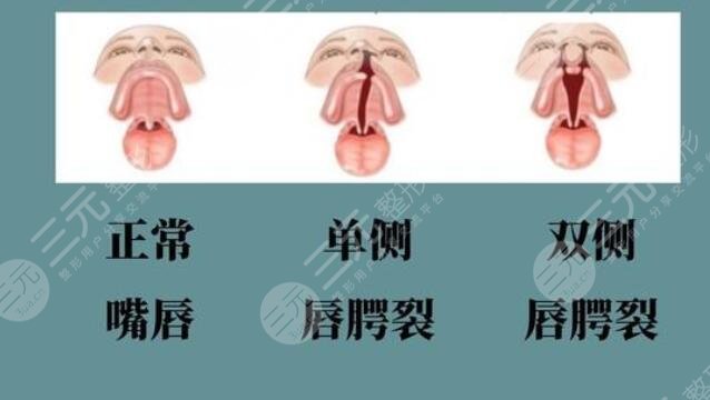 唇裂术后应该注意什么