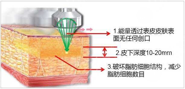 超脂塑溶脂如何选择医院