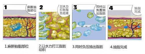 水动力吸脂减肥价格是多少,3个收费影响因素