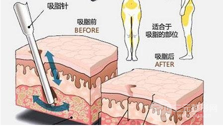 抽脂减肥方法