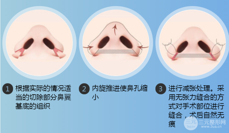 鼻翼缩小手术果维持时间