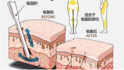 吸脂手术对身体的伤害