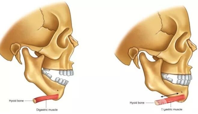 当病人处于开放咬合状态时，二腹肌前腹部在治疗过程中会根据下颌的逆时针旋转而受到拉力(如下图)