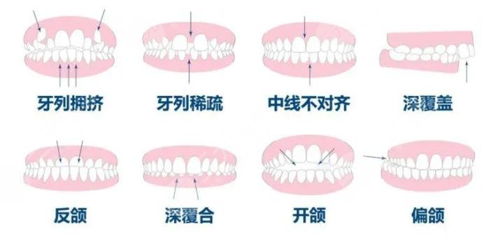 牙齿矫正