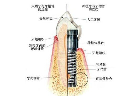 重医口腔医院种植牙多少钱