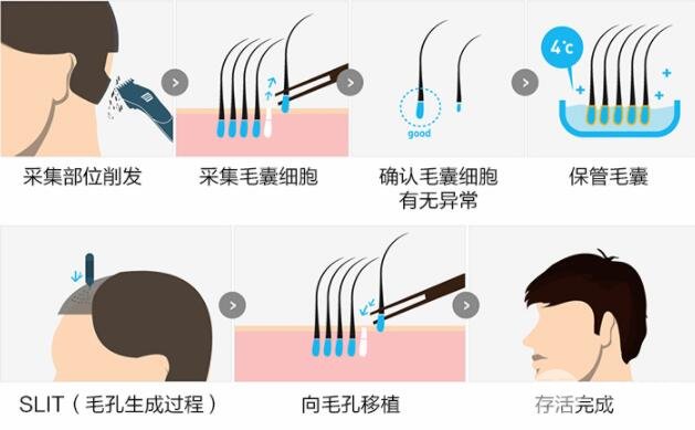 天津总医院植发流程 技术