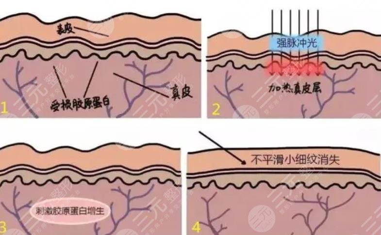 光子嫩肤